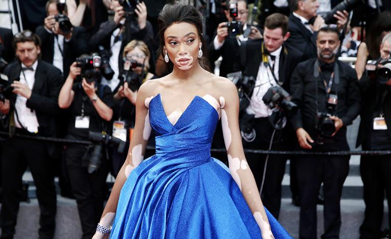 Winnie Harlow: Το μοντέλο που αλλάζει τα πρότυπα ομορφιάς!